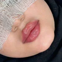 تزریق فیلرو بوتاکس در مطب زیبایی