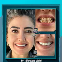 دندانپزشکی زیبایی و درمانی لمینت کامپوزیت دندان|خدمات آرایشگری و زیبایی|شیراز, معالی‌آباد|دیوار