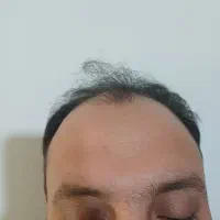 اموزش ژل بوتاکس و تمام خدمات مزو تراپی|خدمات آموزشی|مشهد, چهارچشمه|دیوار