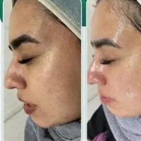 فشیال تخصصی صورت درخانه با قیمت مناسب