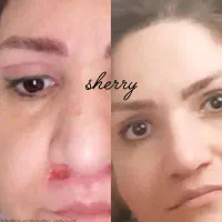 خدمات حرفه ای پاکسازی ریموو تتو و فیشال و جوانسازی|خدمات آرایشگری و زیبایی|هشتگرد, فاز ۱ مهستان|دیوار