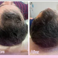 درمان قطعی ریزش مو و رد مجدد مو با پکیج درمانی H3