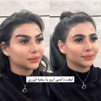 جراحی لیفت ابرو،دایرکت ابرو،لیفت شقیق ،پیشانی