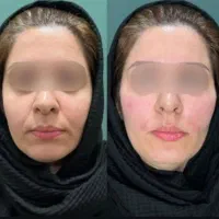 جراحی بینی ، پیکرتراشی ،لیپوماتیک، کاشت ابرو|خدمات آرایشگری و زیبایی|شهریار, شهریار|دیوار