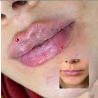 تزریق ژل وبوتاکس