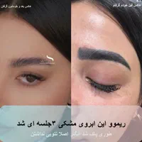 ریموو و پاک کردن تتوهای قدیمی|خدمات آرایشگری و زیبایی|تبریز, |دیوار