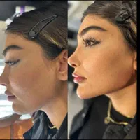 تزریق ژل و بوتاکس فقط ۵۰۰هزارتومان|خدمات آرایشگری و زیبایی|فولادشهر, B2|دیوار