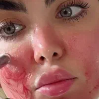 میکرونیدلینگ جوانساز