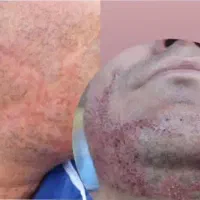 کاشت ریش طبیعی با شرایط اقساطی|خدمات زیبایی و سلامت|تبریز, |دیوار