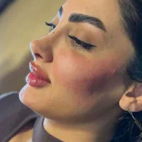 تزریق ژل و بوتاکس