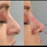 تخصص حرفه ای تزریق لب روسی|خدمات آرایشگری و زیبایی|ارومیه, |دیوار