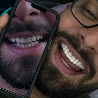 کامپوزیت دندان جشنواره تخفیفی ویژه