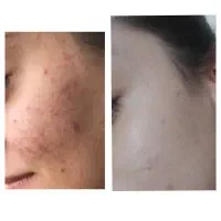 پوست هلویی زیبا بدون تزریق