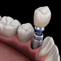 با ۹ میلیون صاحب ایمپلنت کره ایی شوید