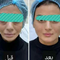 جشنواره تخفیف ژل و بوتاکس و جوانساز