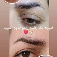 ریمو تک جلسه ایی بدون اسیب ب پوست و مو