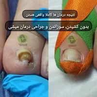 درمان ناخن فرو رفته درگوشت بدون جراحی در کلینیک