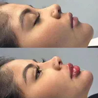 لیفت نخ انزیم ژل وبوتاکس پلاسما تتوبدن فشیال...|خدمات آرایشگری و زیبایی|قم, باجک دو|دیوار