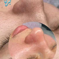 جای جوش و لک رو به پوست صافتر تبدیل کن|خدمات زیبایی و سلامت|اصفهان, وحید|دیوار