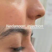 نیازمند مدل ژل و بوتاکس|خدمات آرایشگری و زیبایی|اهواز, کیانپارس |دیوار