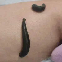 خدمات کلینیک حجامت ، فصد، بادکش، زالو