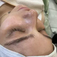 فیشال و پاکسازی پوست،مزونیدلینگ و پلکسر