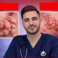 درمان محرمانه زگیل تناسلی غیرحضوری با کمترین هزینه