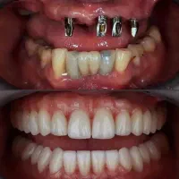 ایمپلنت دیجیتال یک روزه اقساط۲۴ ماهه بدون سود