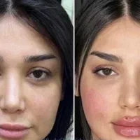 جشنواره ژل بوتاکس.فیلرلیفت نخ.بوتاکس.انزیم.پی ارپی|خدمات آرایشگری و زیبایی|مشهد, سناباد|دیوار