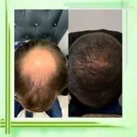 تقویت کننده ریش،مو،ابرو و مژه