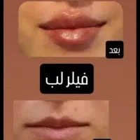 ژل لب گونه چونه زاویه مادلینگ راویه سازی|خدمات آرایشگری و زیبایی|قم, تولید دارو و یخچال|دیوار