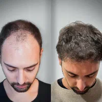 کاشت مو پرتراکم و تضمینی فقط ۱۵ میلیون|خدمات آرایشگری و زیبایی|تهران, جردن|دیوار