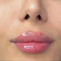 تزریقات زیبایی توسط پزشک با قیمت استثنایی