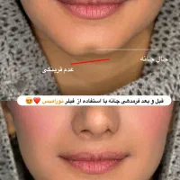 تزریق ژل لب بوتاکس مزو نخ آنزیم لیفت پکیج۱۰ سی سی|خدمات آرایشگری و زیبایی|تهران, مرزداران|دیوار
