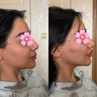 تزریق ژل و بوتاکس و مزوتراپی و فیشال تخصصی