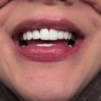 آموزش کامپوزیت دندان