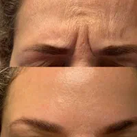 ژل لب/فیلر بادی/ مزوژل/بوتاکس /در کلینیک زیبایی|خدمات آرایشگری و زیبایی|تهران, الهیه|دیوار