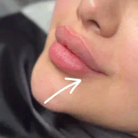 فروش و مدل ژل و بوتاکس