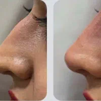 لیفت نخ فیلر بینی لیفت ابرو شقیقه صورت غبغب لاغری