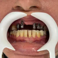 ایمپلنت دیجیتال اقساطی بدون سود در انواع برندها|خدمات آرایشگری و زیبایی|شیراز, زرگری|دیوار