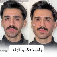 جشنواره تخفیف فیلر فول فیس ژل بوتاکس نخ هایفو|خدمات آرایشگری و زیبایی|مشهد, فرهنگ|دیوار