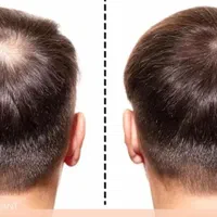 راهکار طبیعی برای بهبود ریزش مو و رویش مجدد آن|آرایشی، بهداشتی، درمانی|گنبد کاووس, |دیوار