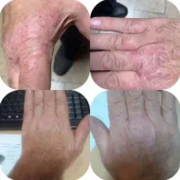 ترمیم زخم سوختگی|آرایشی، بهداشتی، درمانی|قم, حنیف نژاد|دیوار