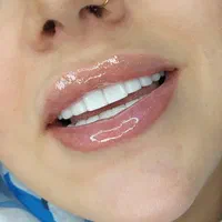 کامپوزیت دندان ((ویژه))|خدمات آرایشگری و زیبایی|یاسوج, |دیوار