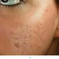 ژل وبوتاکس.برداشتن خال.فیلربینی انزیم پاککردن تاتو|خدمات آرایشگری و زیبایی|مشهد, طبرسی شمالی|دیوار