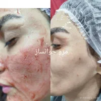 پلکسر وخال برداری ، مزونیدلینگ ، فشیال تخصصی|خدمات آرایشگری و زیبایی|مشهد, طلاب|دیوار