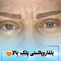 جشنواره تخفیفات بلفاروپلاستی پلک توسط جراح