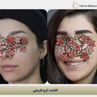 کاشت مو، کاشت ابرو، بلفارو، عمل بینی، رفع غبغب|خدمات آرایشگری و زیبایی|کرج, فاز ۱ مهرشهر|دیوار