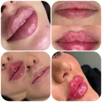 ۵۰درصدتخفیف ژل،بوتاکس،هایفو،بلفارو،انواع لیفت صورت
