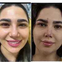 کوچک شدن بینی تضمینی فقط با ۵ میلیون|خدمات آرایشگری و زیبایی|تهران, هاشمی|دیوار